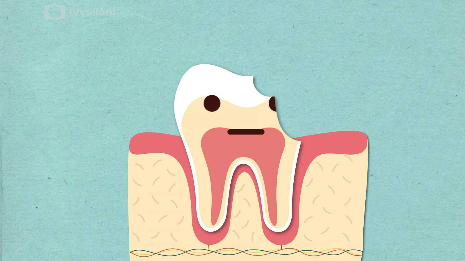 Jak vznikají zubní kazy?