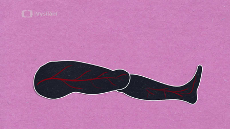 Co způsobuje mravenčení v noze?